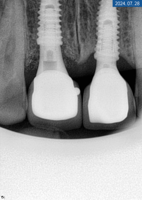 앞니 임플란트 식립으로 저작 기능을 끌어올린 증례 관련 이미지 14