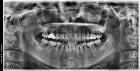 신사역 매복 사랑니 4개 발치 꼭 해야하나요? 관련 이미지 9