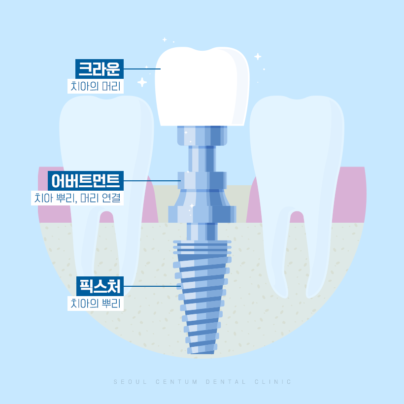 임플란트 크라운 종류 토요일과 일요일도 여는 치과에서 안내! 관련 이미지 3