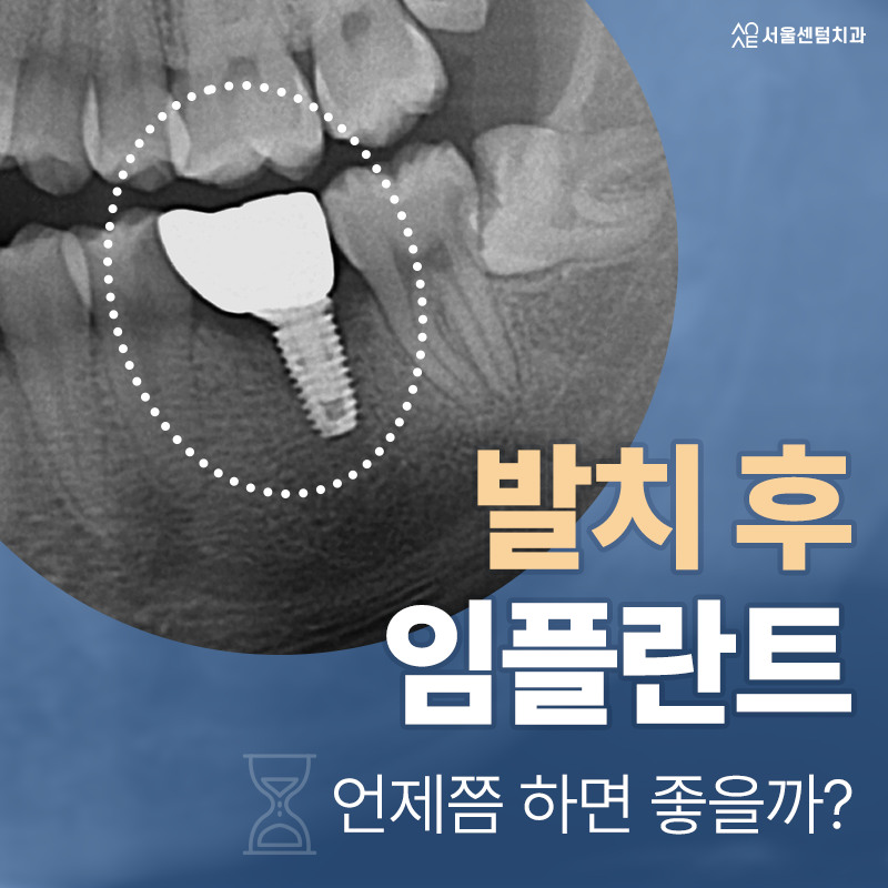 발치 후에 들어가는 임플란트 시기 어떤 기준으로 결정이? 관련 이미지 1