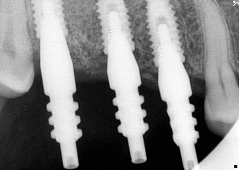 40대 임플란트 치료 케이스 상악동거상술 골이식까지 관련 이미지 10