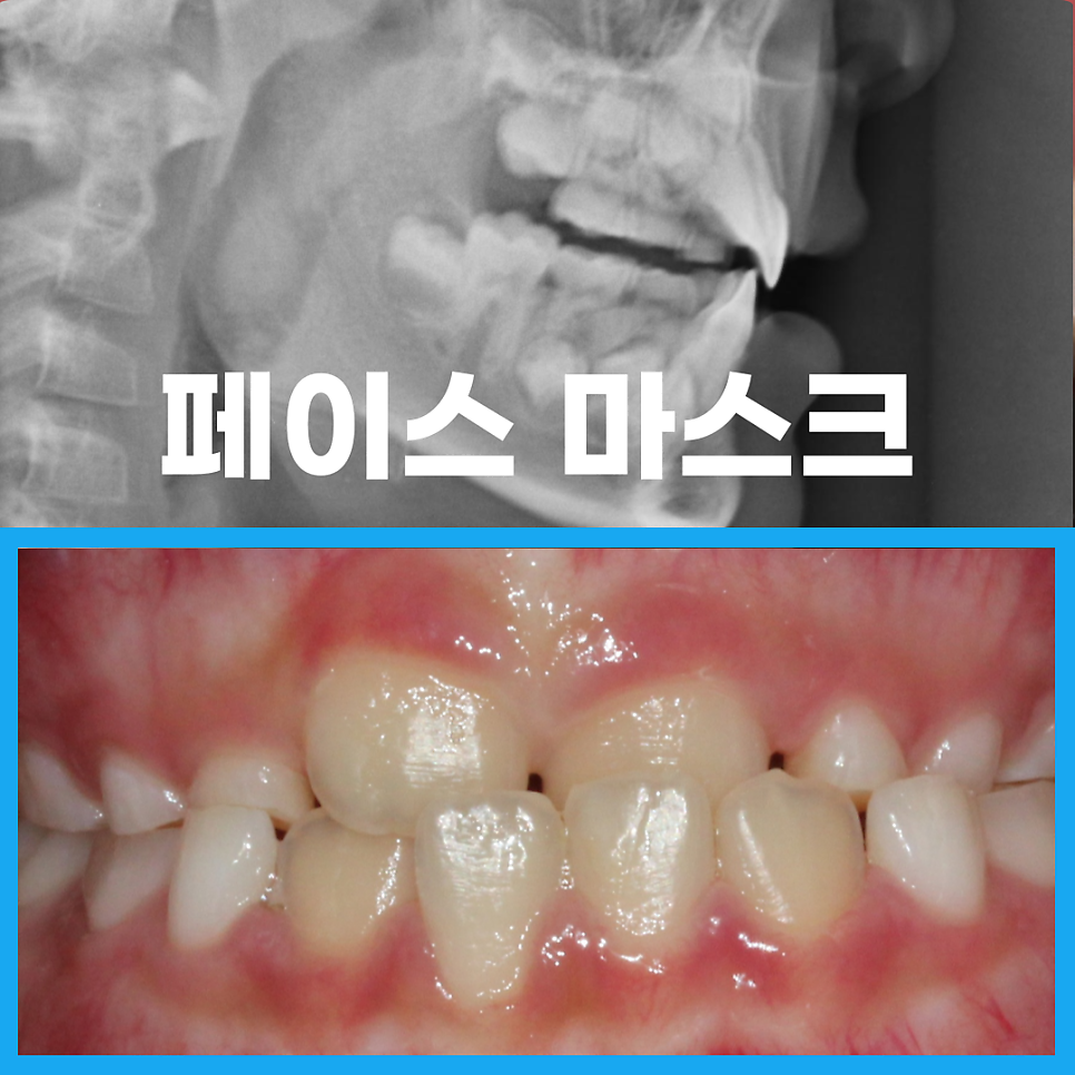 주걱턱 교정, 페이스마스크 활용 주의사항 관련 이미지 1
