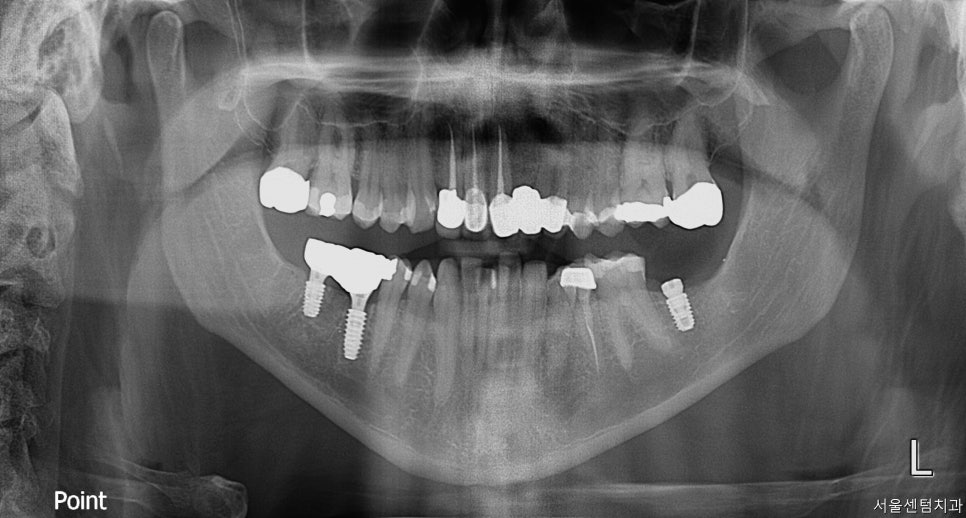 신사역치과 발치후 임플란트 시술과정 30대 남성 케이스 관련 이미지 8