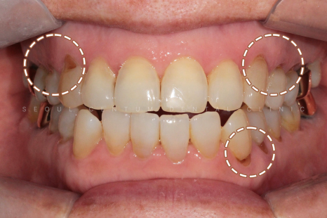 치아패임 이대로 두어도 괜찮을까요 치경부마모증 레진치료 관련 이미지 15