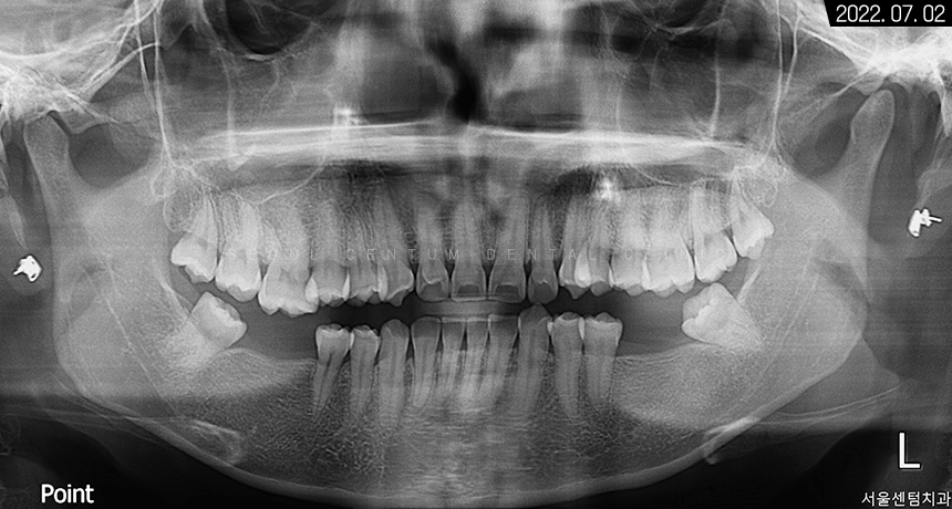 돌출입 및 신경치료와 임플란트 식립 동시 진행 증례 관련 이미지 3