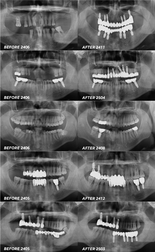 임플란트당일흡연 굳이 문제 생길 일 있을까요 하다가 큰일납니다 관련 이미지 6