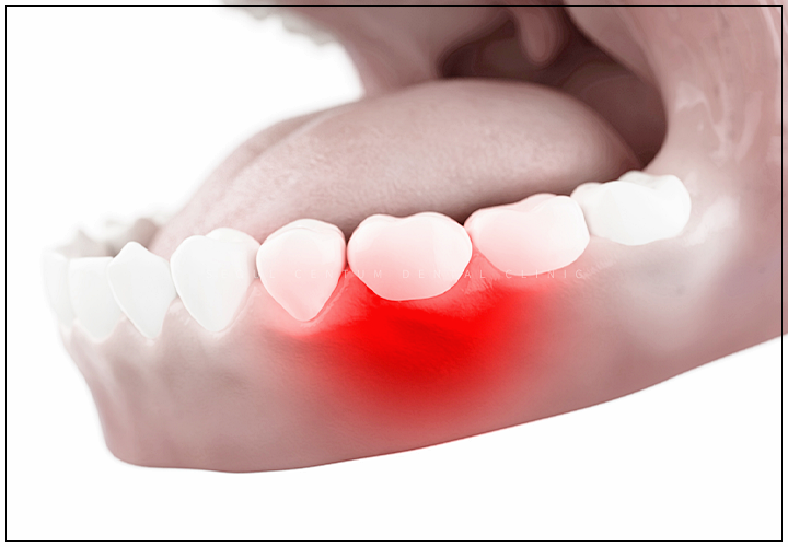 임플란트 뼈이식이 필요한 경우 구체적으로 확인하고 싶다면 관련 이미지 5