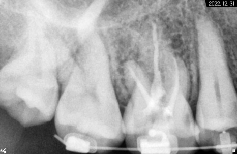 돌출입 및 신경치료와 임플란트 식립 동시 진행 증례 관련 이미지 12
