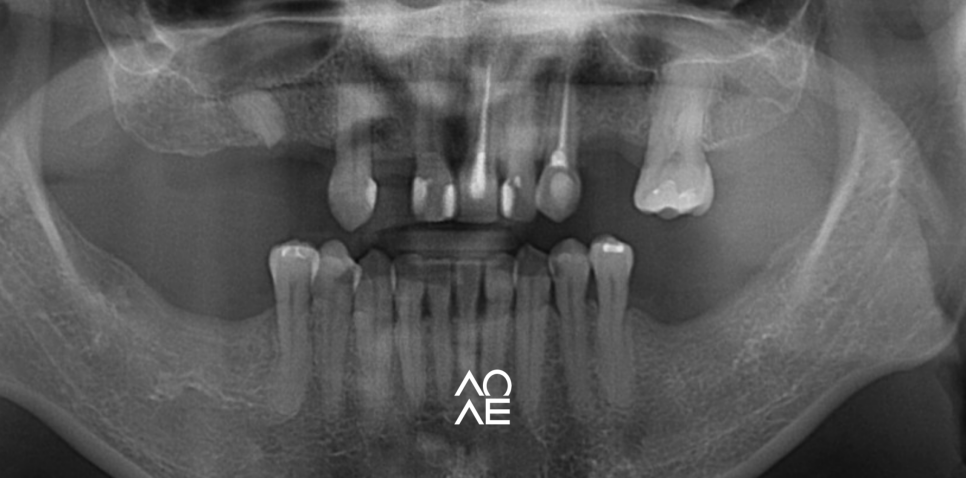 국민 건강보험 임플란트 노인 무치악의 기준은? 관련 이미지 7
