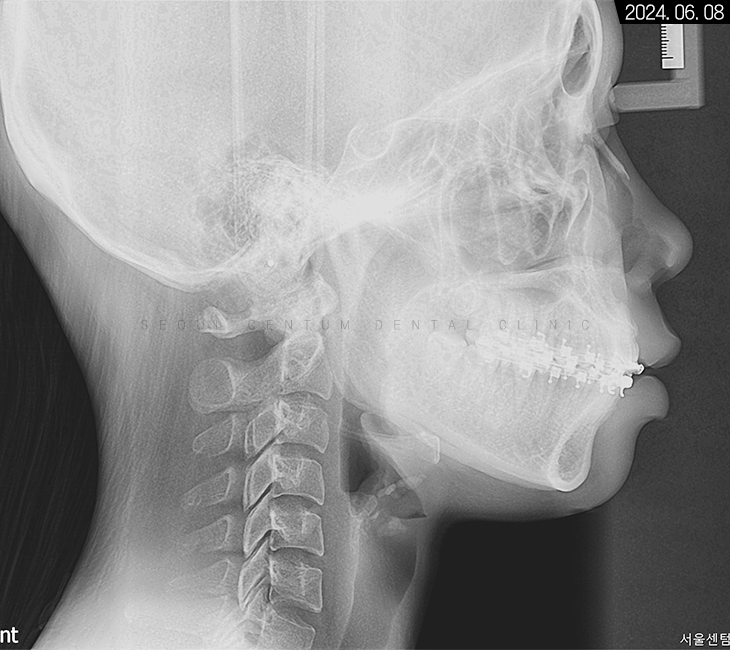 비발치로 돌출입 해소한 증례 관련 이미지 7