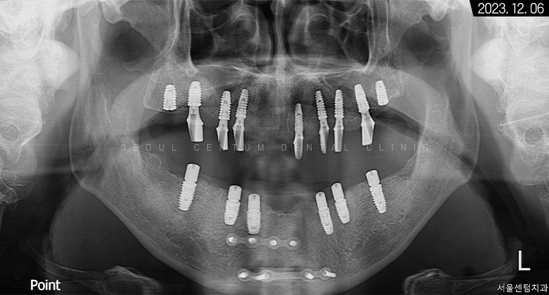 전체임플란트 기간 예상보다 줄어들 수 있는 방법과 증례 공개 관련 이미지 13
