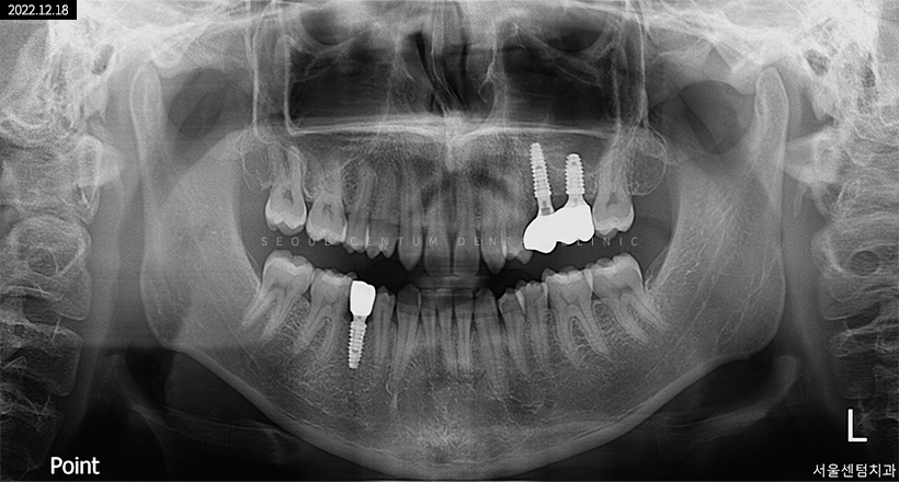 임플란트2차수술과정 언제 필요한지 핵심만 짚어보기 관련 이미지 5