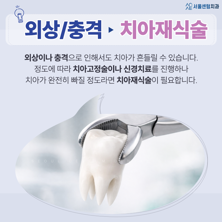 흔들리는 치아 가만히 두지 말고 즉각 치료받아야 하는 경우는? 관련 이미지 4