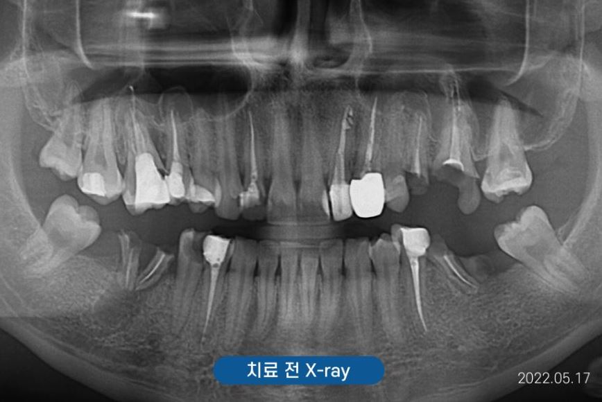 신사역주말치과 갑자기 어금니 이빨 부러졌다면 관련 이미지 3