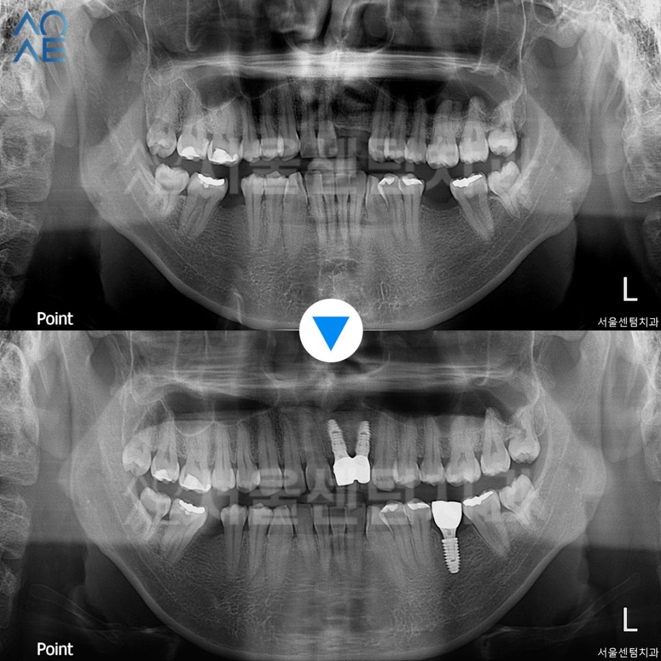 앞니 임플란트 후기 실제사례 보여드려요 관련 이미지 5