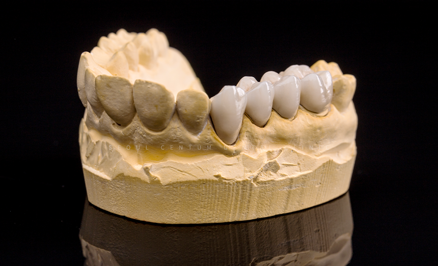 앞니 임플란트 식립으로 저작 기능을 끌어올린 증례 관련 이미지 16