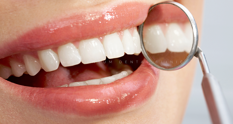 라미네이트전후 치아의 가지런한 정도와 밝기 차이 확인하기 관련 이미지 15