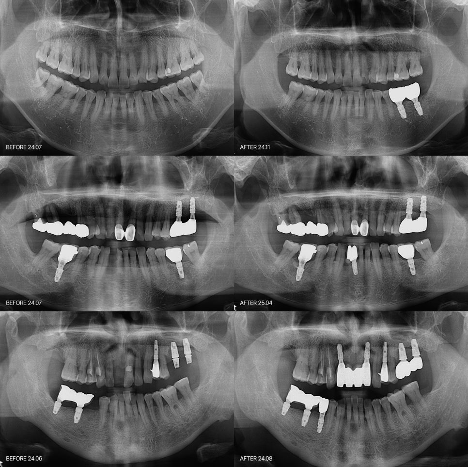 임플란트의 붓기 통증 잇몸에서 시작되는 신호일 수 있습니다 관련 이미지 7