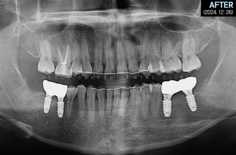 돌출입 및 신경치료와 임플란트 식립 동시 진행 증례 관련 이미지 32