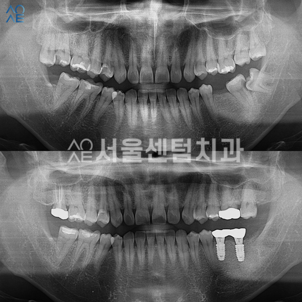 치아 신경치료 단계 임플란트까지 고려한다면 관련 이미지 6
