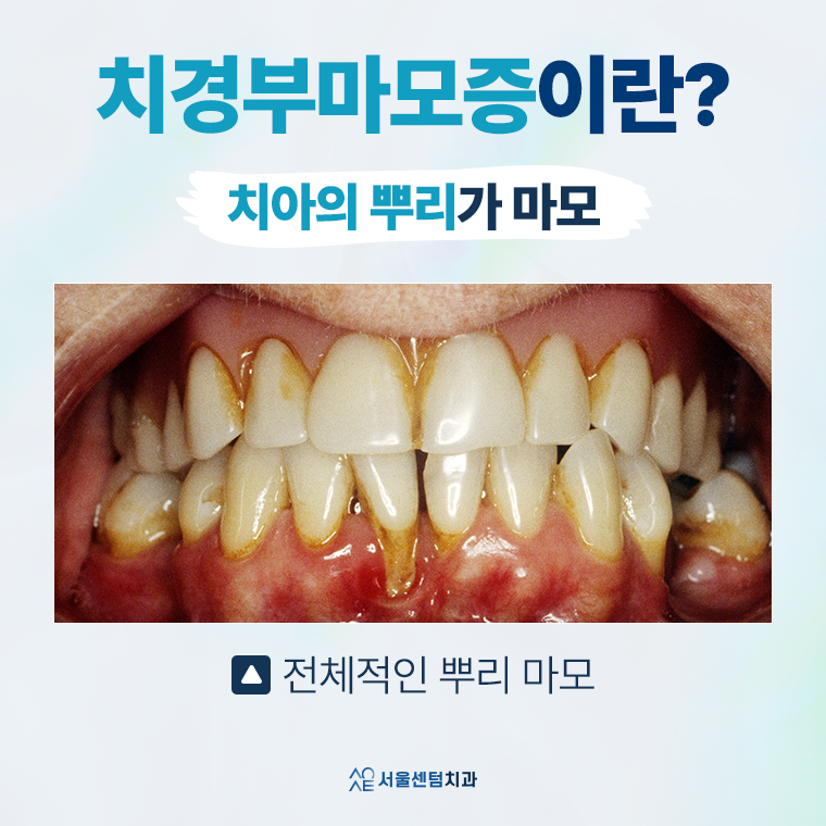 치경부마모증 가격 gi 레진 갈색치아 원인 통증 관련 이미지 2