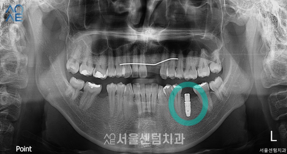 앞니 임플란트 후기 실제사례 보여드려요 관련 이미지 2