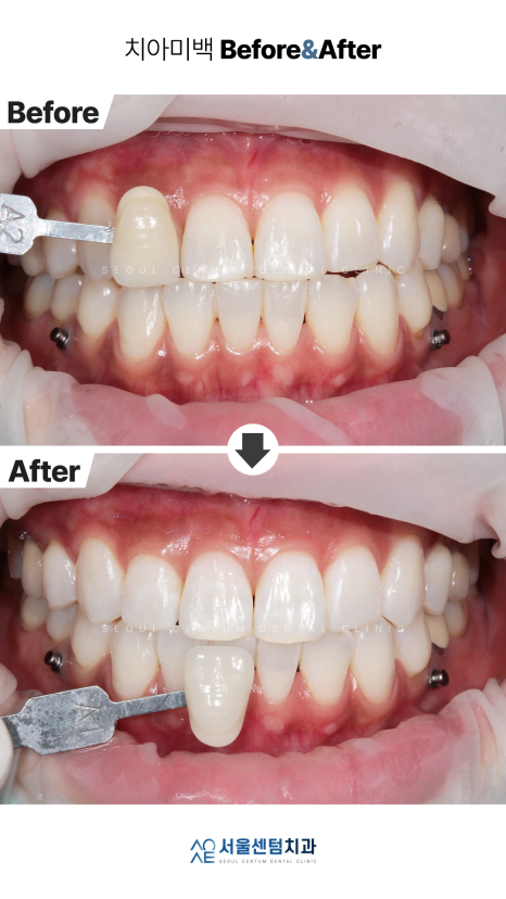 치과치아미백 전후 사진과 종류 소개 관련 이미지 7