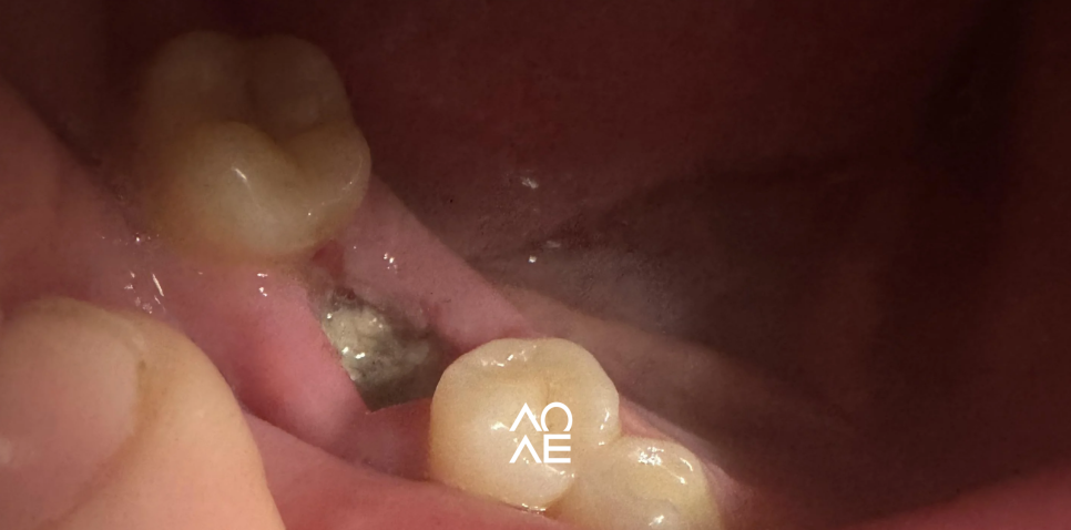 드라이소켓 건성치조와 증상 치료에 대해 관련 이미지 4