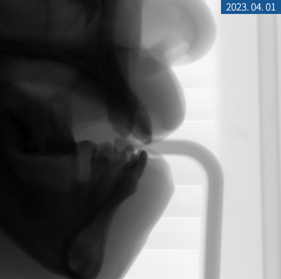 임플란트 브릿지와 크라운 수복으로 치아 기능을 회복시킨 증례 관련 이미지 8