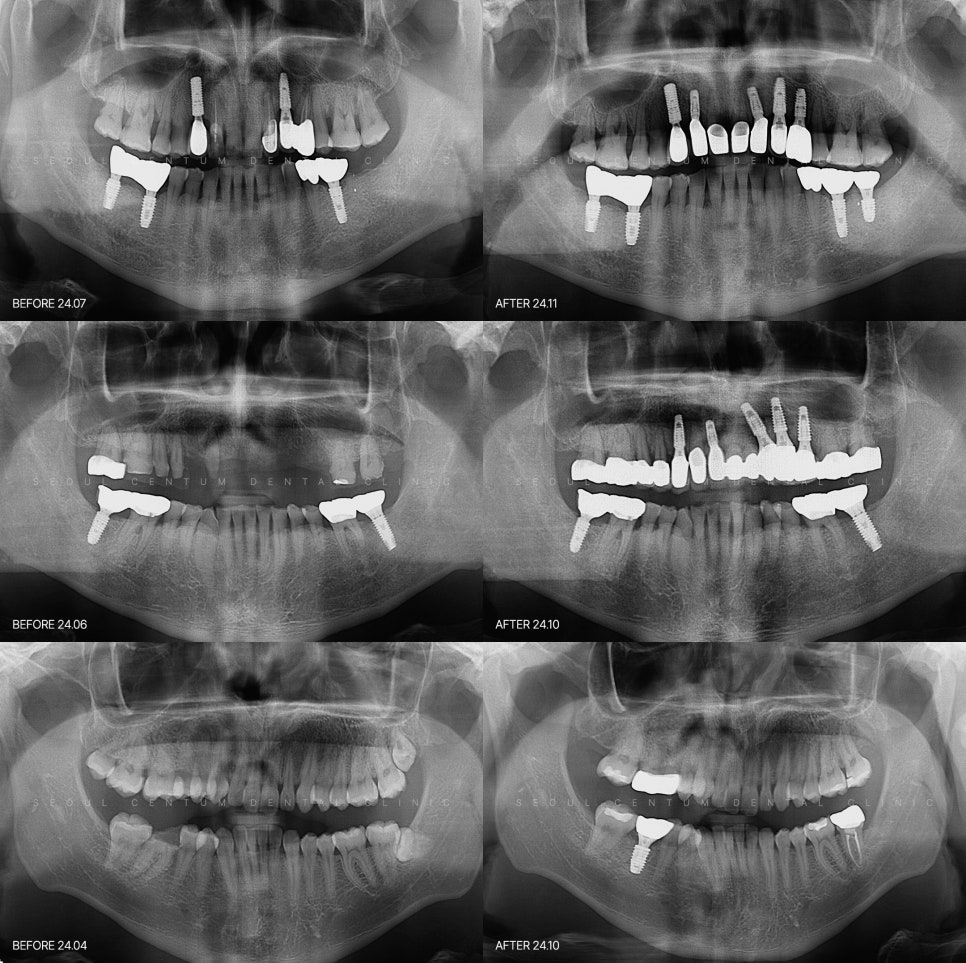 잇몸퇴축 레진치료 생각보다 간단하거든요 관련 이미지 6