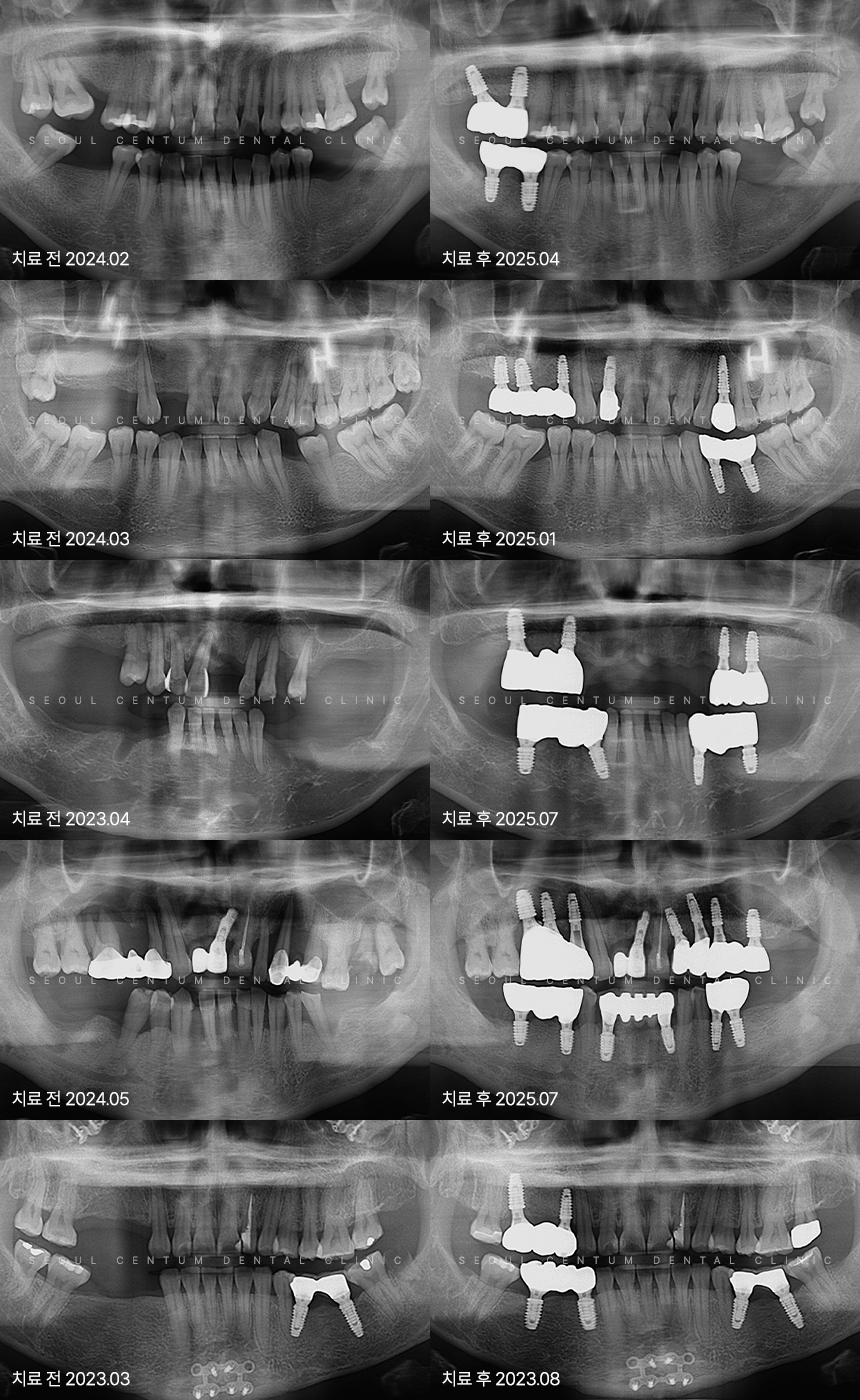 임플란트 틀니 가격 치과마다 다른 진짜 이유가 있다? 관련 이미지 6