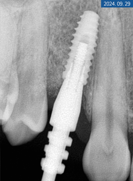 뼈이식 임플란트와 라미네이트 수복 증례 소개 관련 이미지 13