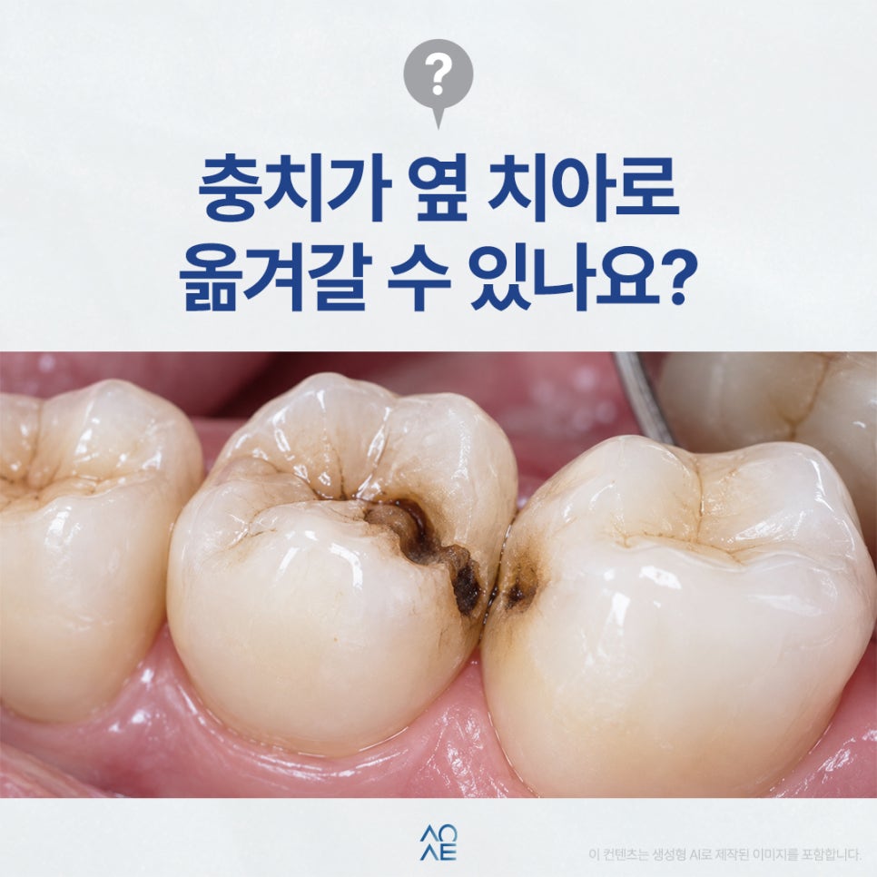 치아 사이 충치 옆까지 옮겨질 수 있나요? 관련 이미지 1