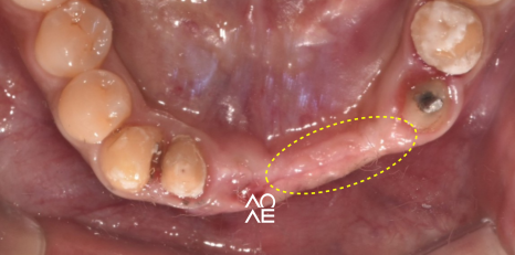 임플란트 뼈이식 필요한 경우 기간은? 관련 이미지 6