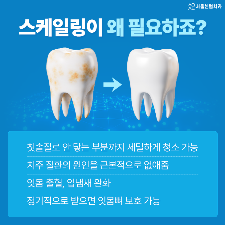 치아 스케일링 주기 알아두면 구강 질환 걱정 끝 관련 이미지 2