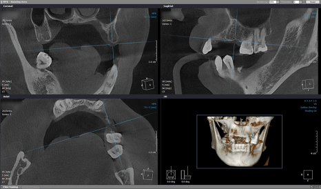 임플란트 브릿지와 크라운 수복으로 치아 기능을 회복시킨 증례 관련 이미지 5