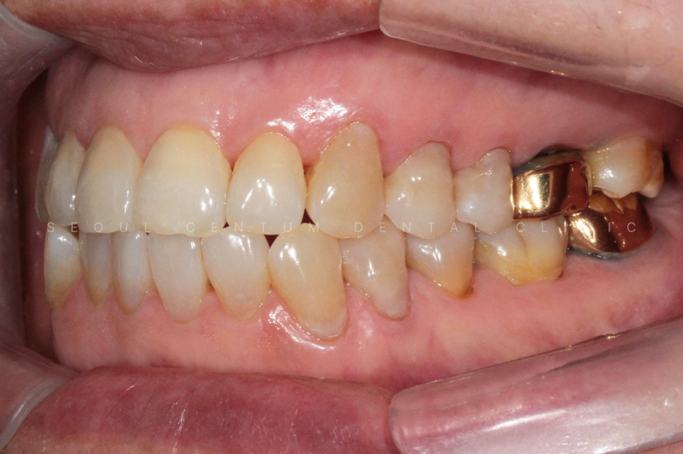 치경부마모증 가격 gi 레진 갈색치아 원인 통증 관련 이미지 15