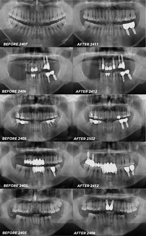 Why You Must Not Ignore a Loose Dental Implant image 8