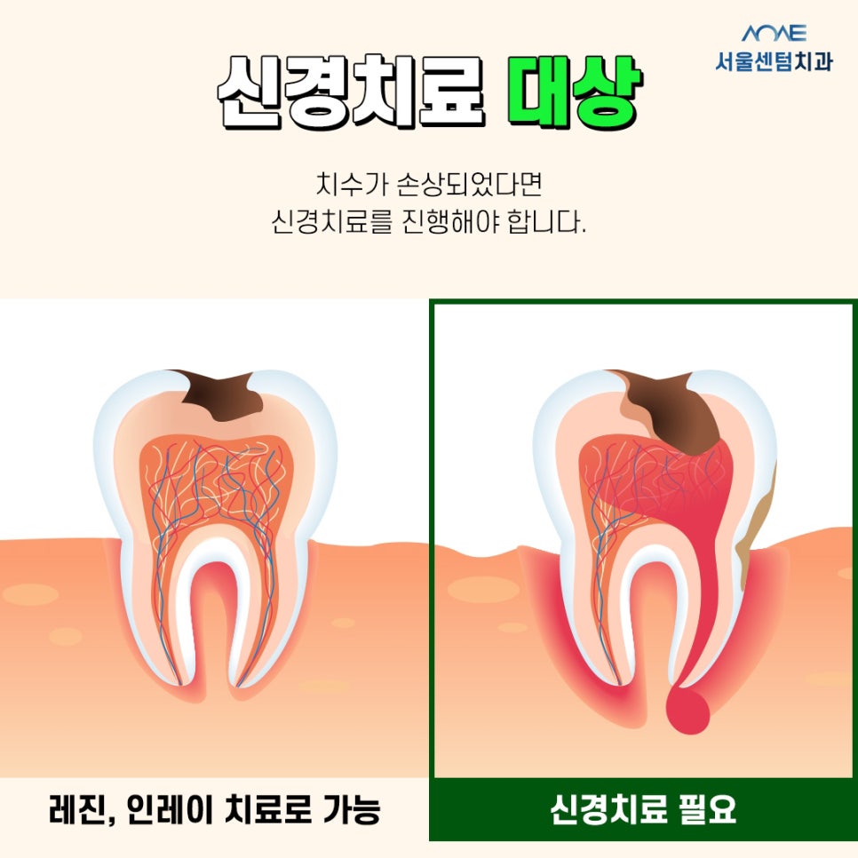 Explaining the Root Canal Treatment Process with Actual Dental Photos image 1