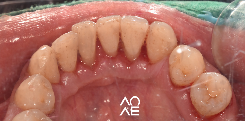 잠원동 스케일링 후 통증 당연히 있을 수 있습니다. 관련 이미지 4