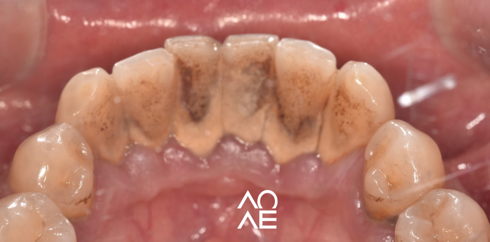 잠원동 스케일링 후 통증 당연히 있을 수 있습니다. 관련 이미지 3