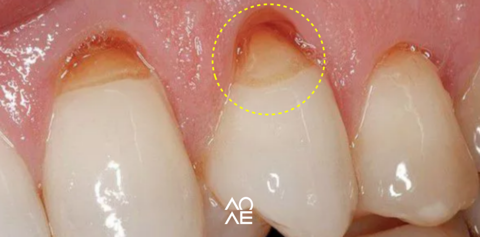 찬물 이시림 잇몸패임 원인 2가지, 치료법 관련 이미지 2