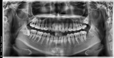 신사역 매복 사랑니 4개 발치 꼭 해야하나요? 관련 이미지 6