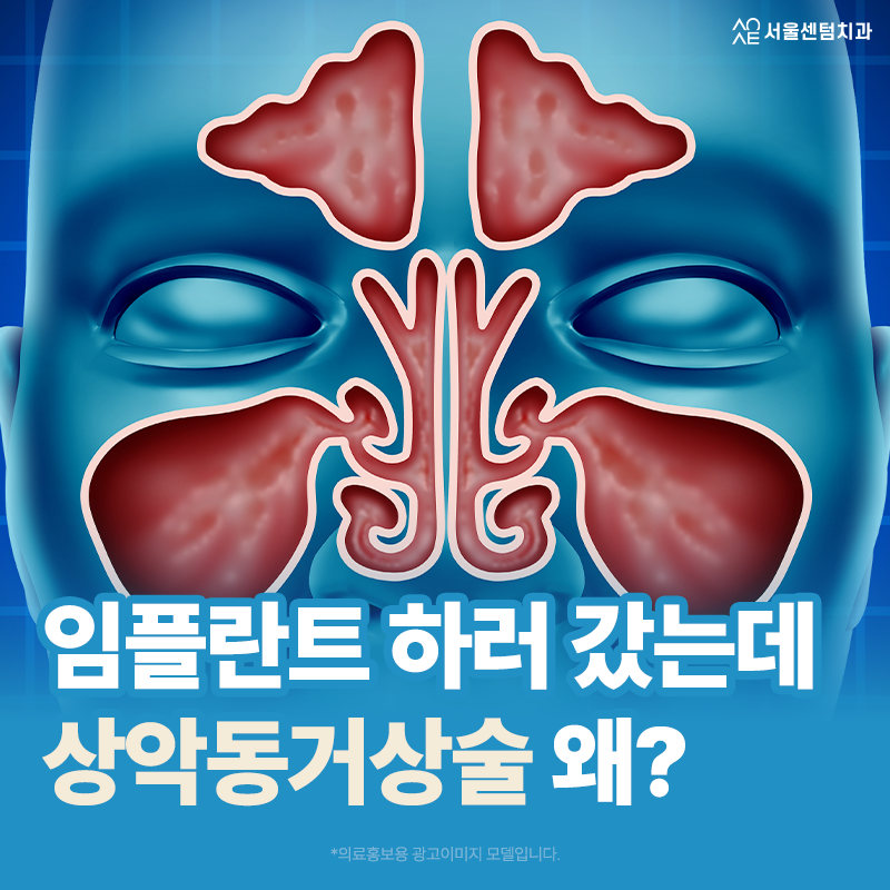 Pain After a Sinus Lift: Why Is It Suddenly Necessary When You Went to the Dentist for Implants? image 1