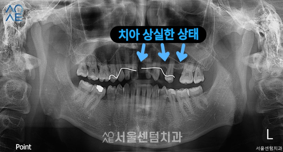 앞니 임플란트기간 실제 수술사례로 알려드려요 관련 이미지 1