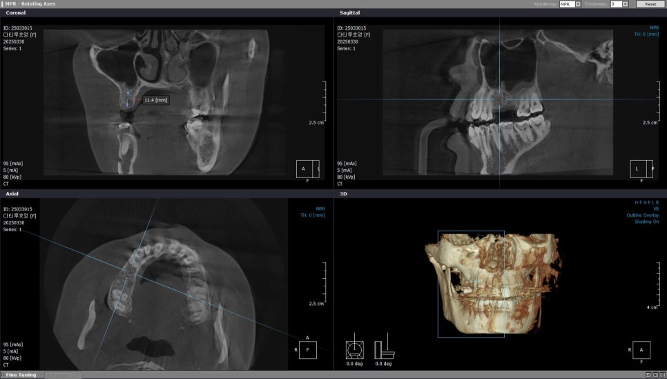 40대 임플란트 치료 케이스 상악동거상술 골이식까지 관련 이미지 4