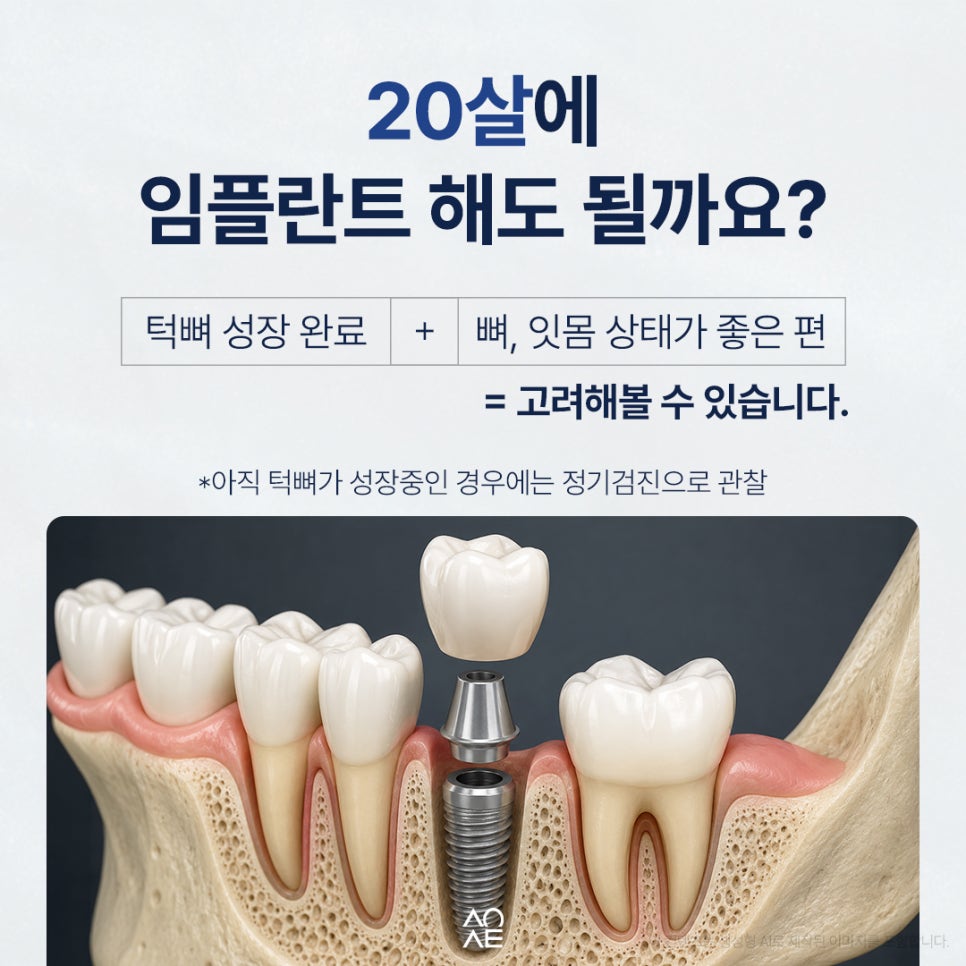 20대 임플란트 해도 괜찮을까요? 아직 나이도 초반인데 어쩌죠 관련 이미지 5