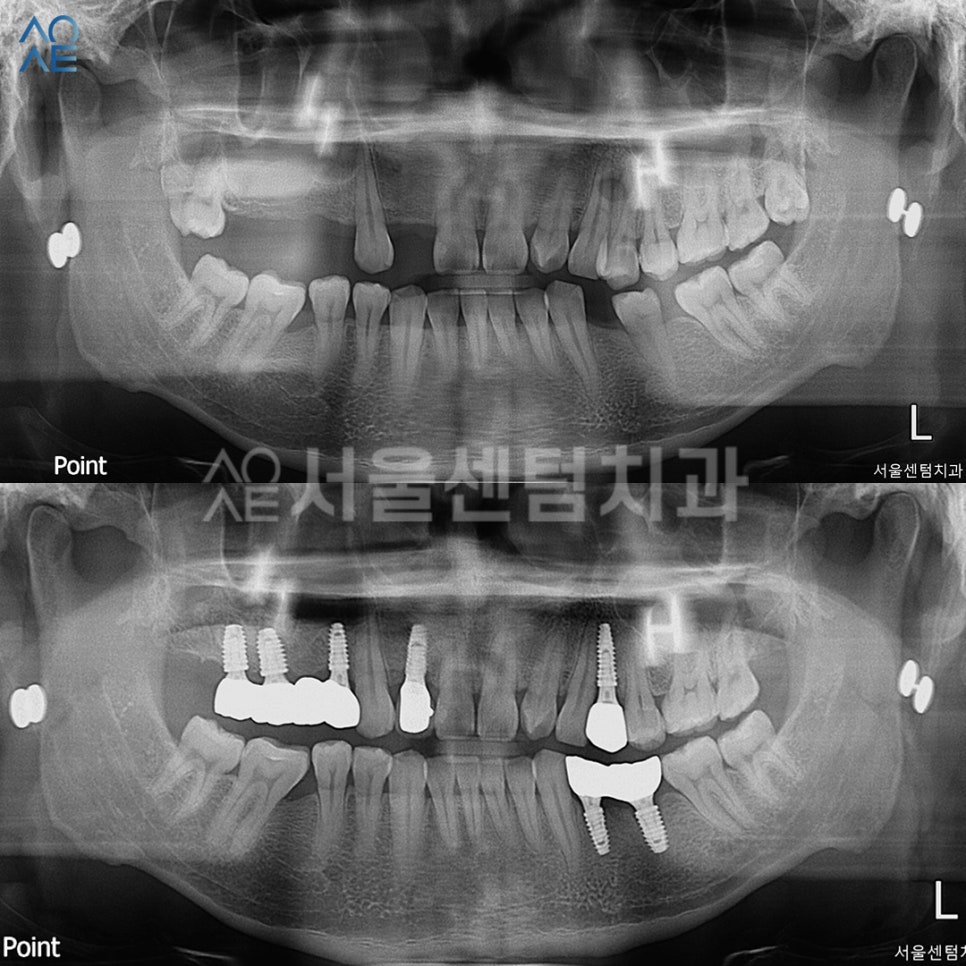 임플란트 과정 기간 실제 사례로 설명드려요 관련 이미지 7