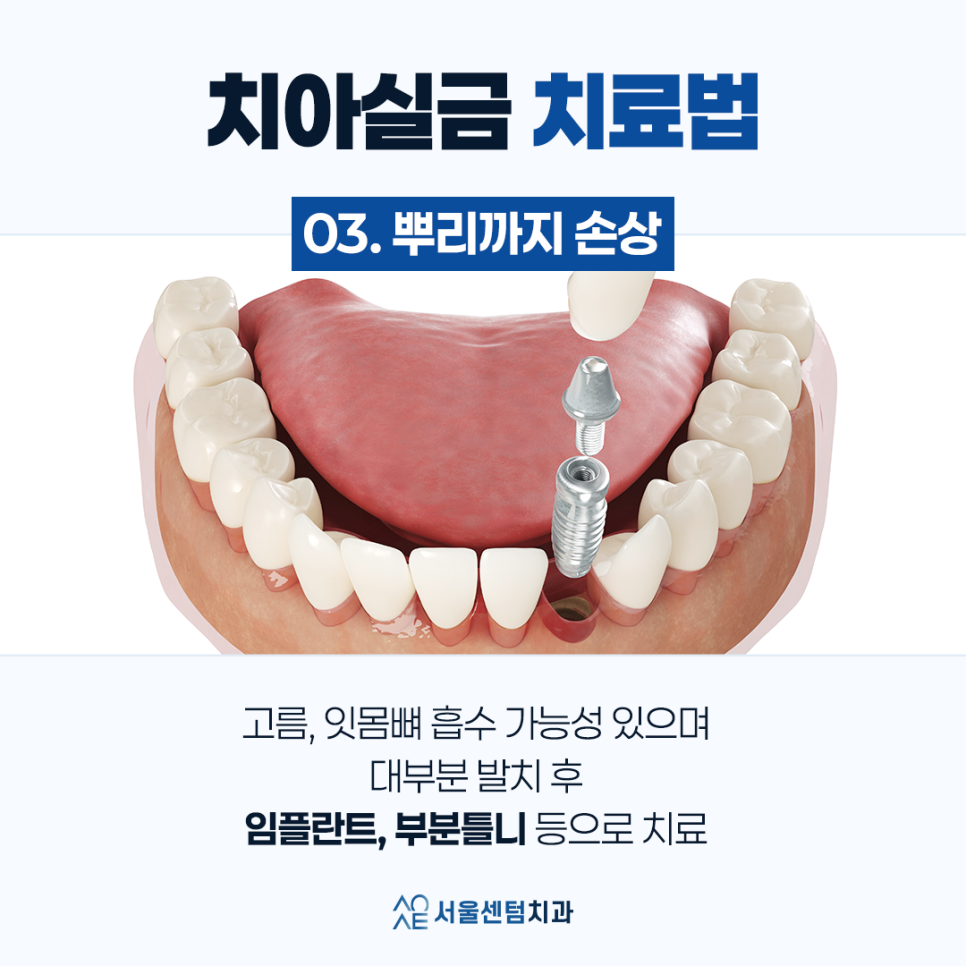 치아실금 신경쓰인다면 이것 체크하세요 관련 이미지 6