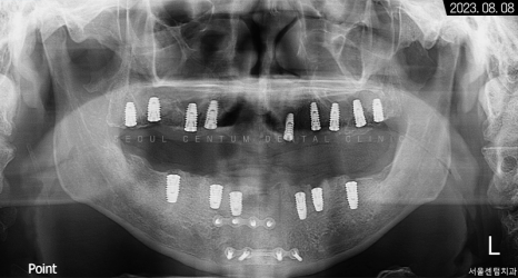 전체임플란트 기간 예상보다 줄어들 수 있는 방법과 증례 공개 관련 이미지 10